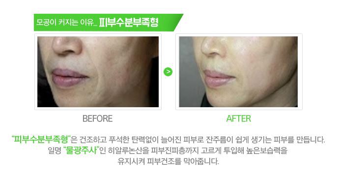 원주 피부과 모공을 작게 피부 탄력 살리다